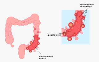 Симптомы и лечение дивертикулёза сигмовидной кишки