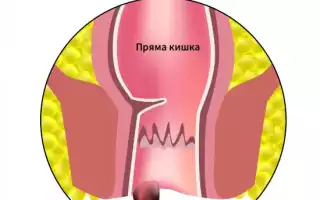 Как определить внутренний геморрой?