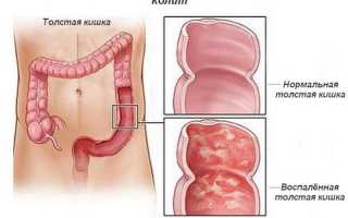 Колит у ребенка