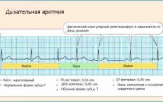 Синусовая дыхательная аритмия у взрослых