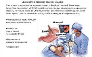 Как определить язву 12-перстной кишки, диагностика язвенной болезни