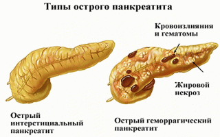 Острый интерстициальный панкреатит