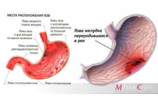 Язва желудка лопнула, первые признаки разрыва, причины и последствия