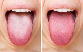 Налет на языке и его цвет при панкреатите, заболевании поджелудочной железы