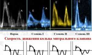 Сердечная недостаточность с сохраненной фракцией выброса