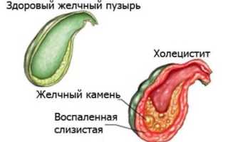 Симптомы и признакихолецистита и панкреатита – их лечение, чем отличаются?