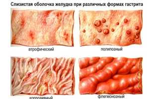 Поверхностный гастрит в стадии обострения