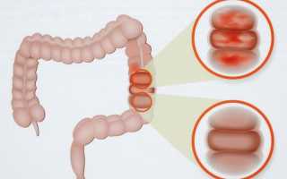 Лечение хронического колита