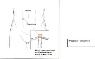 Операция при болезни Крона