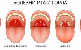 Причины появления слизи в кале и горле при глистах