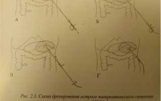 Хирургия острого панкреатита, операция (хирургическое лечение)