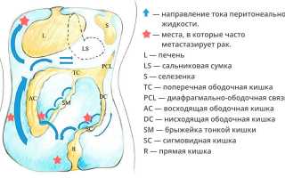 Метастазы рака желудка, сколько живут с ними, пути метастазирования