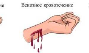 Правильный способ остановки капиллярного кровотечения кратко