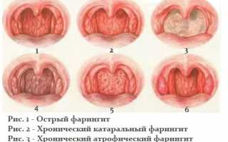 Фарингит гастрит