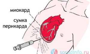 Тампонада перикарда
