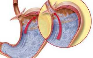 Гастрит с рефлюксом желчи