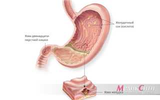 Язва 12-перстной кишки: симптомы, признаки, причины, диагностика, лечение, питание и диета