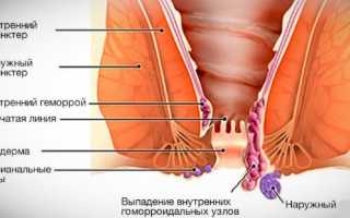 Симптомы (проявления) геморроя у мужчин, как проявляется?