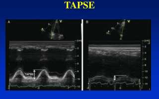 Tapse эхокардиография