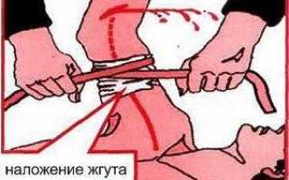 Кровотечения бывают следующих видов венозное артериальное капиллярное