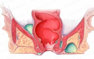 Антибиотики при парапроктите