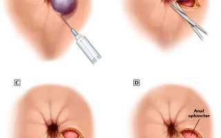 Лечение острого тромбоза наружных и внутренних геморроидальных узлов