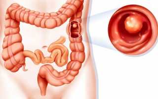 Как осуществляется современная диагностика полипов кишечника