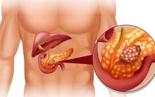 Киста поджелудочной железы (головки и хвоста), симптомы, прогнозы на лечение опухоли, фото
