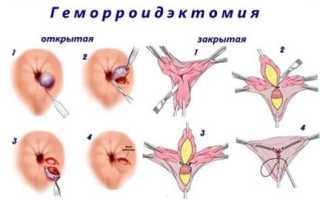 Швы после операции по удалению геморроя