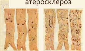 Общий атеросклероз
