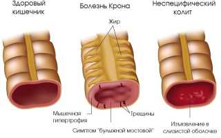 Диагностика неспецифического язвенного колита