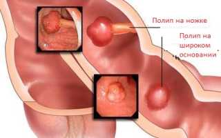 Аденоматозные полипы желудка и кишечника