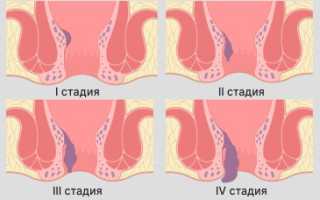 Как отличить геморрой от других болезней, на какие заболевания он похож?