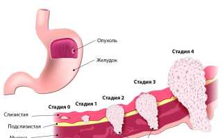 Симптомы и признаки опухоли желудка