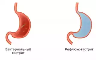 Виды и формы болезни хронический гастрит желудка у детей и беременных