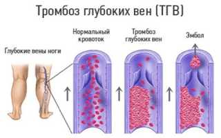Тромбоз глубоких вен нижних конечностей симптомы лечение