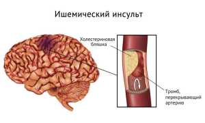 Малый ишемический инсульт