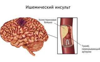 Малый ишемический инсульт