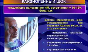 Кардиогенный шок классификация