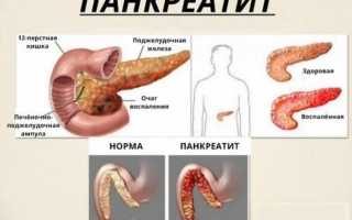 Симптомы реактивного панкреатита, лечение при признаках изменеий поджелудочной железы