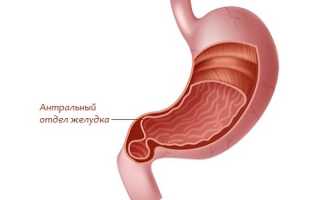 Гастрит антрального отдела желудка, что это такое?