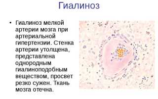 Гиалиноз сосудов головного мозга микропрепарат что это