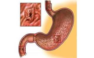 Прободная, перфорированная язва желудка: симптомы, лечение, операция и восстановительный период