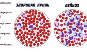 Тромбоцитопения неясного генеза