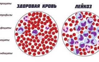 Тромбоцитопения неясного генеза