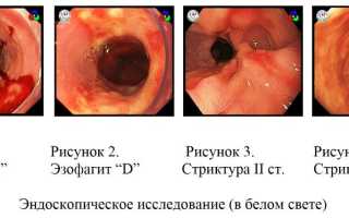 Диагноз – эзофагит