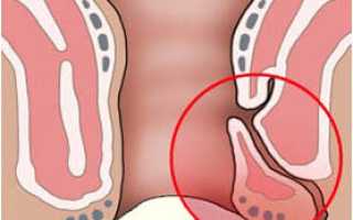 Свищ после парапроктита