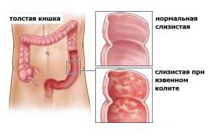 Неспецифический язвенный колит у детей