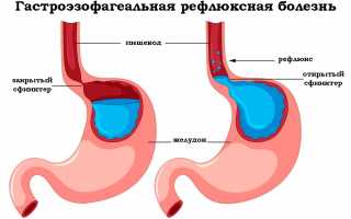 Как лечить эзофагит народными средствами?