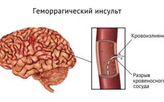 Геморрагический инсульт симптомы первые признаки